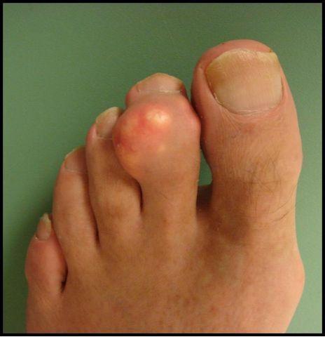Zapalenie stawów stopy: przyczyny, objawy